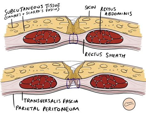 dehiscence meaning.